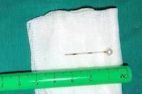 Profesionales extraen un alfiler del pulmón de una niña en Asunción