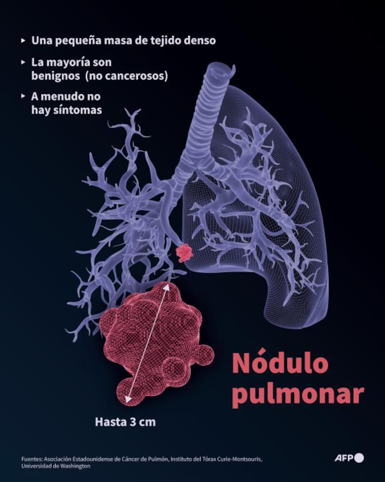 Infografía sobre un nódulo pulmonar con un pequeño crecimiento en el pulmón, generalmente benigno, es decir, no canceroso. (AFP)