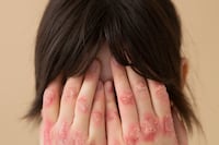 Día Mundial de la Psoriasis: Estrés, tabaquismo y malos hábitos pueden empeorar la enfermedad