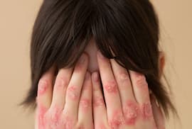 Día Mundial de la Psoriasis: Estrés, tabaquismo y malos hábitos pueden empeorar la enfermedad