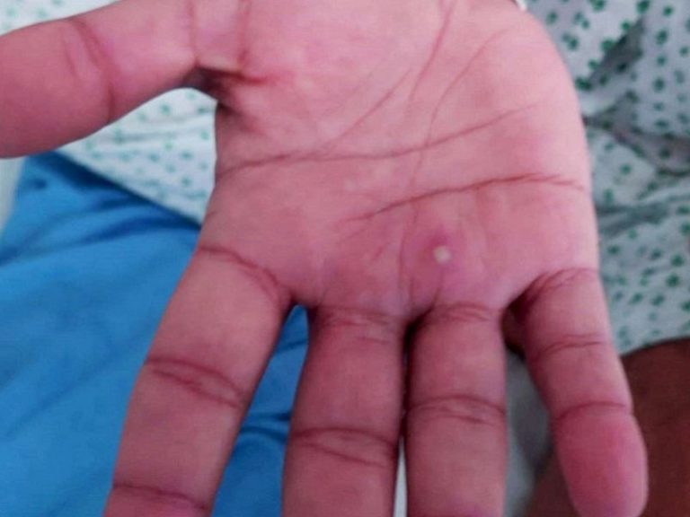 Mucho cuidado: Viruela símica sigue atacando jóvenes de Asunción y Central