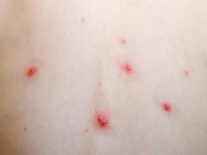 varicela, qué es la varicela, como tratar la varicela